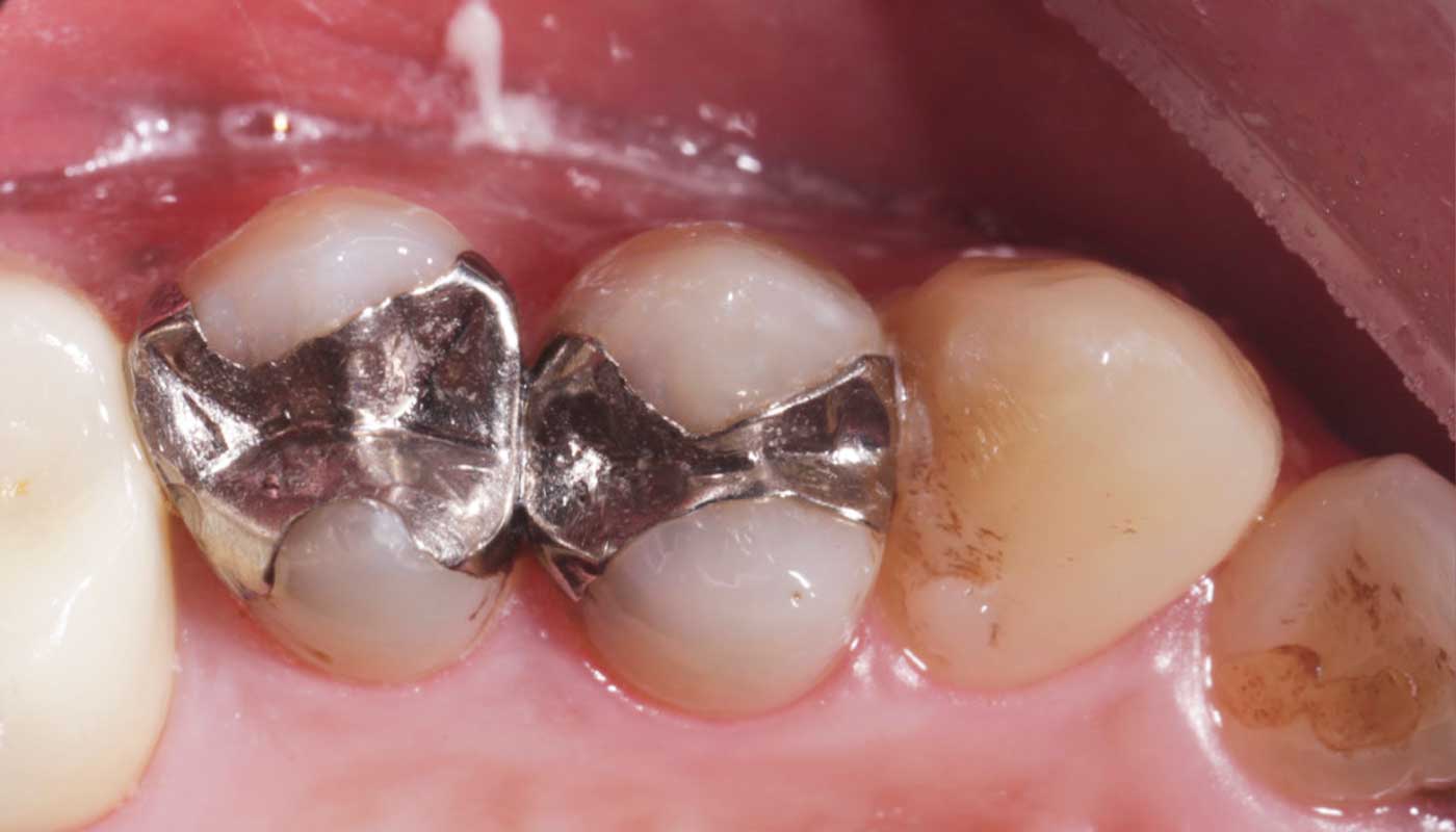 銀歯の虫歯治療