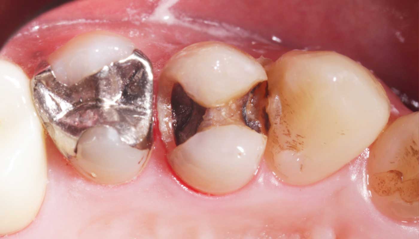 銀歯の虫歯治療