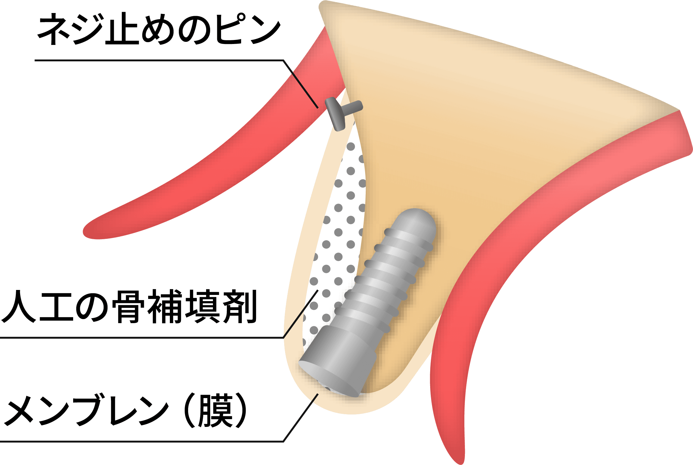 骨補填材による骨再生治療