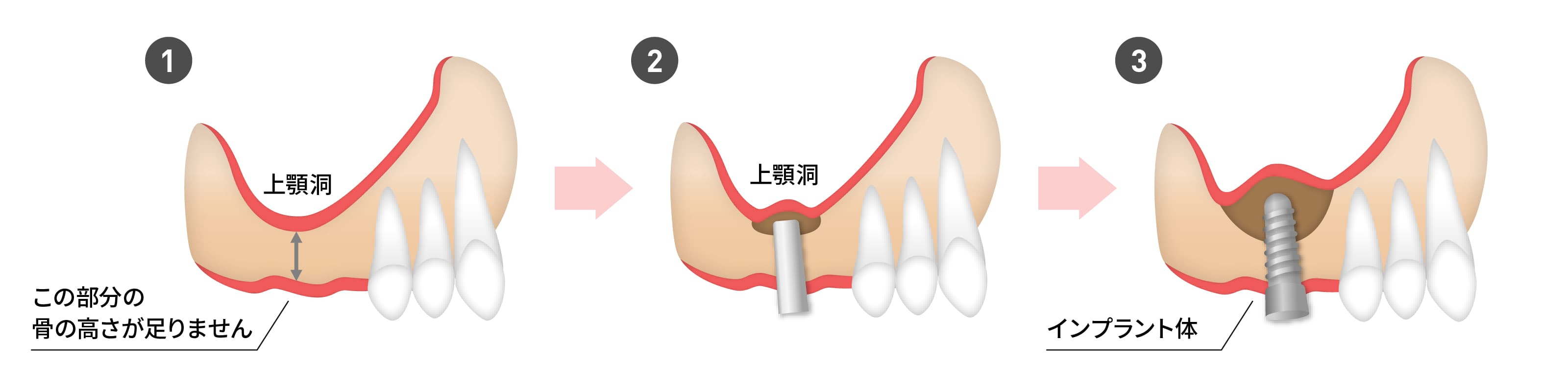 ソケットリフト