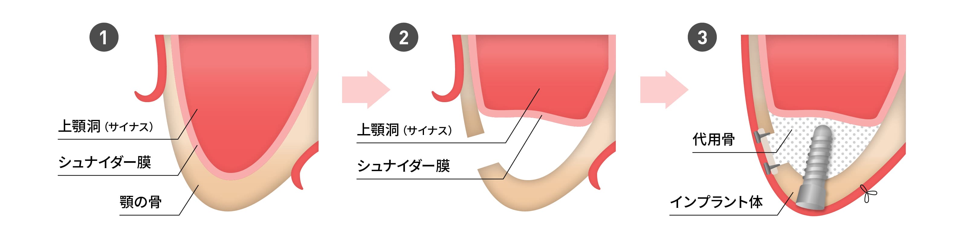 サイナスリフト