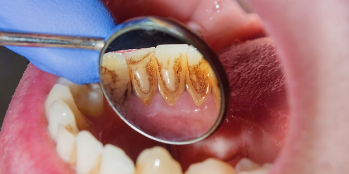 歯槽膿漏治療について