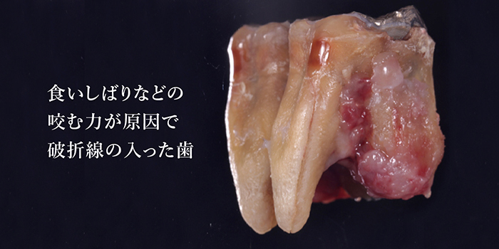 食いしばりなどの咬む力が原因で破折線の入った歯