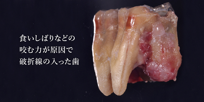 食いしばりなどの咬む力が原因で破折線の入った歯